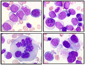 LAM therapy-related, dysplasie multignée 